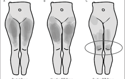 Risposta neurodinamica allo slump test femorale in soggetti con dolore anteriore di ginocchio