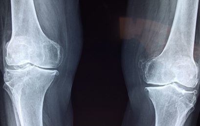 Efficacia della mobilizzazione passiva continua dopo sostituzione protesica di ginocchio