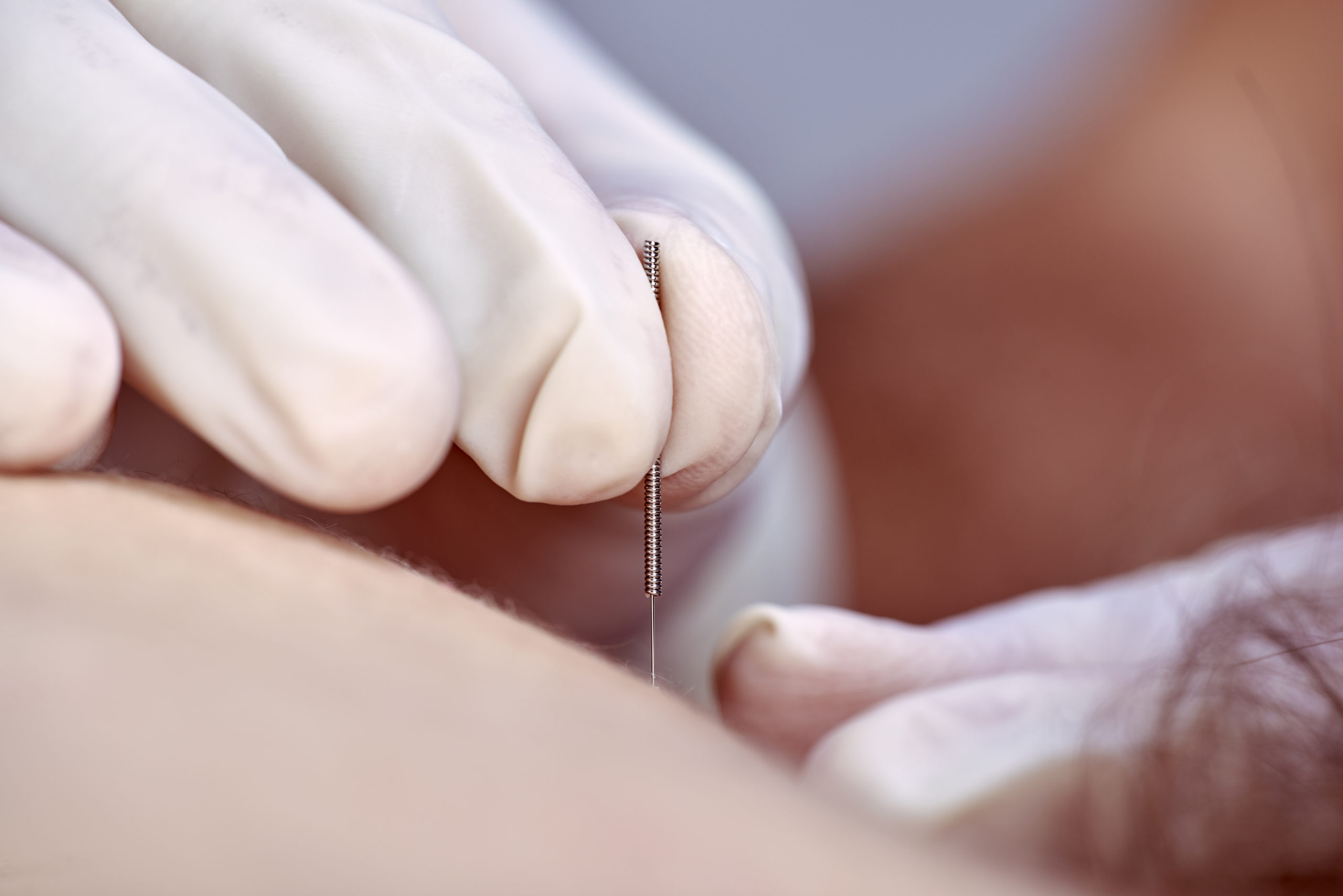 Efficacia del dry needling dopo protesi totale di ginocchio Efficacia del dry needling dopo protesi totale di ginocchio