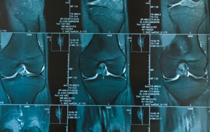 Prevalenza di alterazioni strutturali in ginocchia asintomatiche