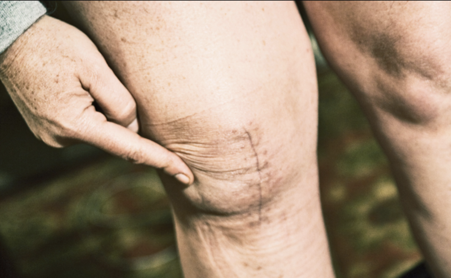 Attività sportive raccomandate dopo protesi di ginocchio Attività sportive raccomandate dopo protesi di ginocchio